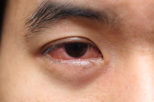 red sore allergy eye